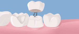 Porcelain-Crown_-CEREC_Fort_Lee_A-Beautiful-Smile-Dentistry_Website