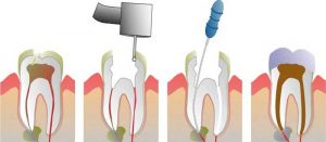 root-canal_Therapy_A-Beautiful-Smile-Dentistry-in-Fort-Lee,-New-Jersey